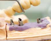 multiple-teeth-implant-houston-doctor-177x142